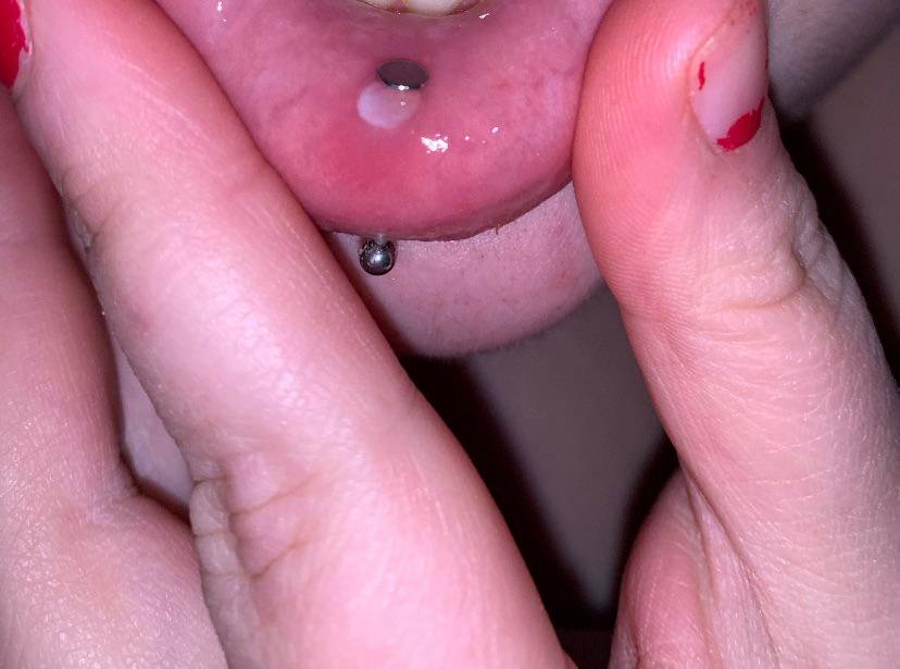 Infection Ashley Piercings Infection Ashley Piercings